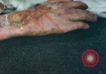 Image of Japanese patient Nagasaki Japan, 1946, second 45 stock footage video 65675060753