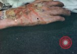 Image of Japanese patient Nagasaki Japan, 1946, second 46 stock footage video 65675060753