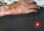 Image of Japanese patient Nagasaki Japan, 1946, second 53 stock footage video 65675060753