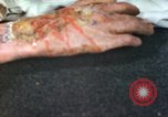 Image of Japanese patient Nagasaki Japan, 1946, second 61 stock footage video 65675060753