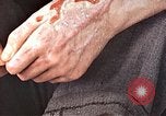 Standbild männlicher Patient Nagasaki Japan, 1946, aus Sekunde 23 historischem Filmmaterial Videoclip 65675060757
