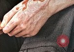 Standbild männlicher Patient Nagasaki Japan, 1946, aus Sekunde 25 historischem Filmmaterial Videoclip 65675060757