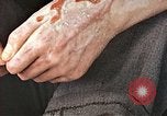 Standbild männlicher Patient Nagasaki Japan, 1946, aus Sekunde 26 historischem Filmmaterial Videoclip 65675060757