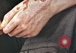 Standbild männlicher Patient Nagasaki Japan, 1946, aus Sekunde 30 historischem Filmmaterial Videoclip 65675060757