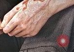Standbild männlicher Patient Nagasaki Japan, 1946, aus Sekunde 34 historischem Filmmaterial Videoclip 65675060757