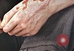 Standbild männlicher Patient Nagasaki Japan, 1946, aus Sekunde 35 historischem Filmmaterial Videoclip 65675060757