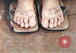 Standbild männlicher Patient Nagasaki Japan, 1946, aus Sekunde 58 historischem Filmmaterial Videoclip 65675060757
