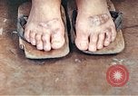 Standbild männlicher Patient Nagasaki Japan, 1946, aus Sekunde 59 historischem Filmmaterial Videoclip 65675060757