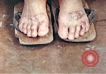 Standbild männlicher Patient Nagasaki Japan, 1946, aus Sekunde 60 historischem Filmmaterial Videoclip 65675060757