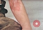 Image of Japanese male patients Nagasaki Japan, 1946, second 30 stock footage video 65675060759