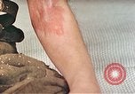 Image of Japanese male patients Nagasaki Japan, 1946, second 31 stock footage video 65675060759