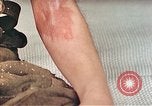 Image of Japanese male patients Nagasaki Japan, 1946, second 33 stock footage video 65675060759