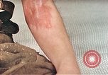 Image of Japanese male patients Nagasaki Japan, 1946, second 34 stock footage video 65675060759