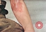Image of Japanese male patients Nagasaki Japan, 1946, second 35 stock footage video 65675060759