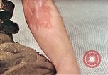 Image of Japanese male patients Nagasaki Japan, 1946, second 36 stock footage video 65675060759