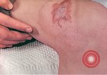 Image of Japanese male patients Nagasaki Japan, 1946, second 45 stock footage video 65675060759