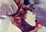 Image of operating a leg Okinawa Ryukyu Islands, 1945, second 4 stock footage video 65675077513