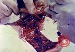 Image of operating a leg Okinawa Ryukyu Islands, 1945, second 5 stock footage video 65675077513