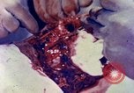 Image of operating a leg Okinawa Ryukyu Islands, 1945, second 6 stock footage video 65675077513