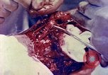 Image of operating a leg Okinawa Ryukyu Islands, 1945, second 10 stock footage video 65675077513