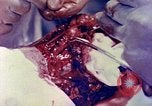 Image of operating a leg Okinawa Ryukyu Islands, 1945, second 11 stock footage video 65675077513