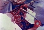 Image of operating a leg Okinawa Ryukyu Islands, 1945, second 12 stock footage video 65675077513
