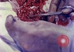Image of operating a leg Okinawa Ryukyu Islands, 1945, second 20 stock footage video 65675077513