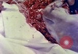 Image of operating a leg Okinawa Ryukyu Islands, 1945, second 23 stock footage video 65675077513