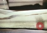Image of Post operative infection California United States USA, 1945, second 62 stock footage video 65675077526