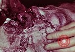 Image of wounded soldier European Theater, 1945, second 52 stock footage video 65675077544