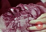 Image of wounded soldier European Theater, 1945, second 56 stock footage video 65675077544
