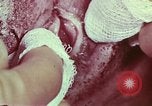 Image of wounded soldier European Theater, 1945, second 61 stock footage video 65675077544