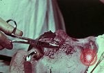 Image of wounded soldier European Theater, 1945, second 4 stock footage video 65675077545