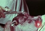 Image of wounded soldier European Theater, 1945, second 5 stock footage video 65675077545