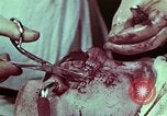 Image of wounded soldier European Theater, 1945, second 6 stock footage video 65675077545