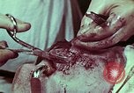 Image of wounded soldier European Theater, 1945, second 7 stock footage video 65675077545