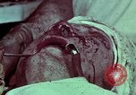 Image of wounded soldier European Theater, 1945, second 25 stock footage video 65675077545
