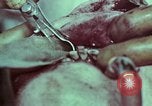 Image of wounded soldier European Theater, 1945, second 31 stock footage video 65675077545