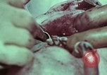 Image of wounded soldier European Theater, 1945, second 33 stock footage video 65675077545