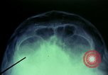Image of wounded soldier European Theater, 1945, second 35 stock footage video 65675077545