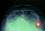 Image of wounded soldier European Theater, 1945, second 36 stock footage video 65675077545