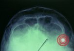 Image of wounded soldier European Theater, 1945, second 37 stock footage video 65675077545