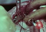 Image of wounded soldier European Theater, 1945, second 39 stock footage video 65675077545