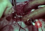 Image of wounded soldier European Theater, 1945, second 41 stock footage video 65675077545