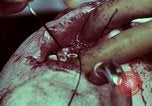 Image of wounded soldier European Theater, 1945, second 43 stock footage video 65675077545