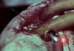 Image of wounded soldier European Theater, 1945, second 44 stock footage video 65675077545
