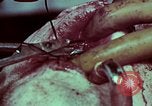 Image of wounded soldier European Theater, 1945, second 45 stock footage video 65675077545