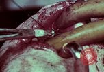 Image of wounded soldier European Theater, 1945, second 47 stock footage video 65675077545