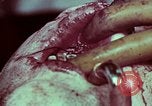 Image of wounded soldier European Theater, 1945, second 48 stock footage video 65675077545