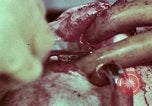 Image of wounded soldier European Theater, 1945, second 50 stock footage video 65675077545